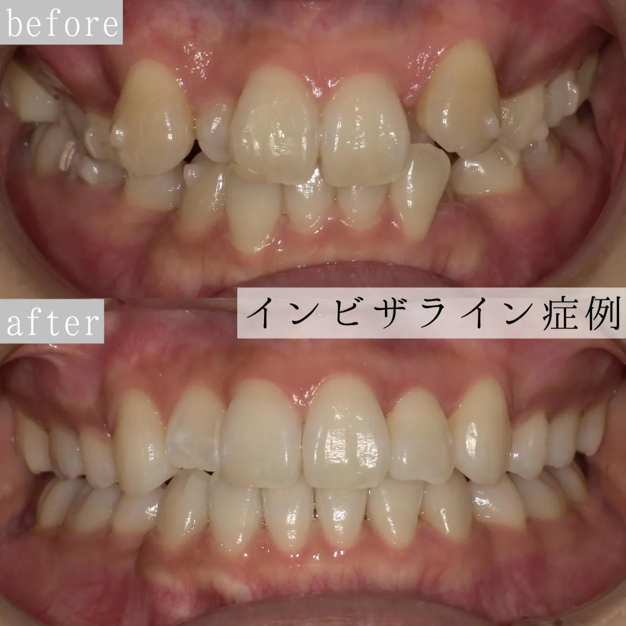 ✨インビザライン症例紹介✨